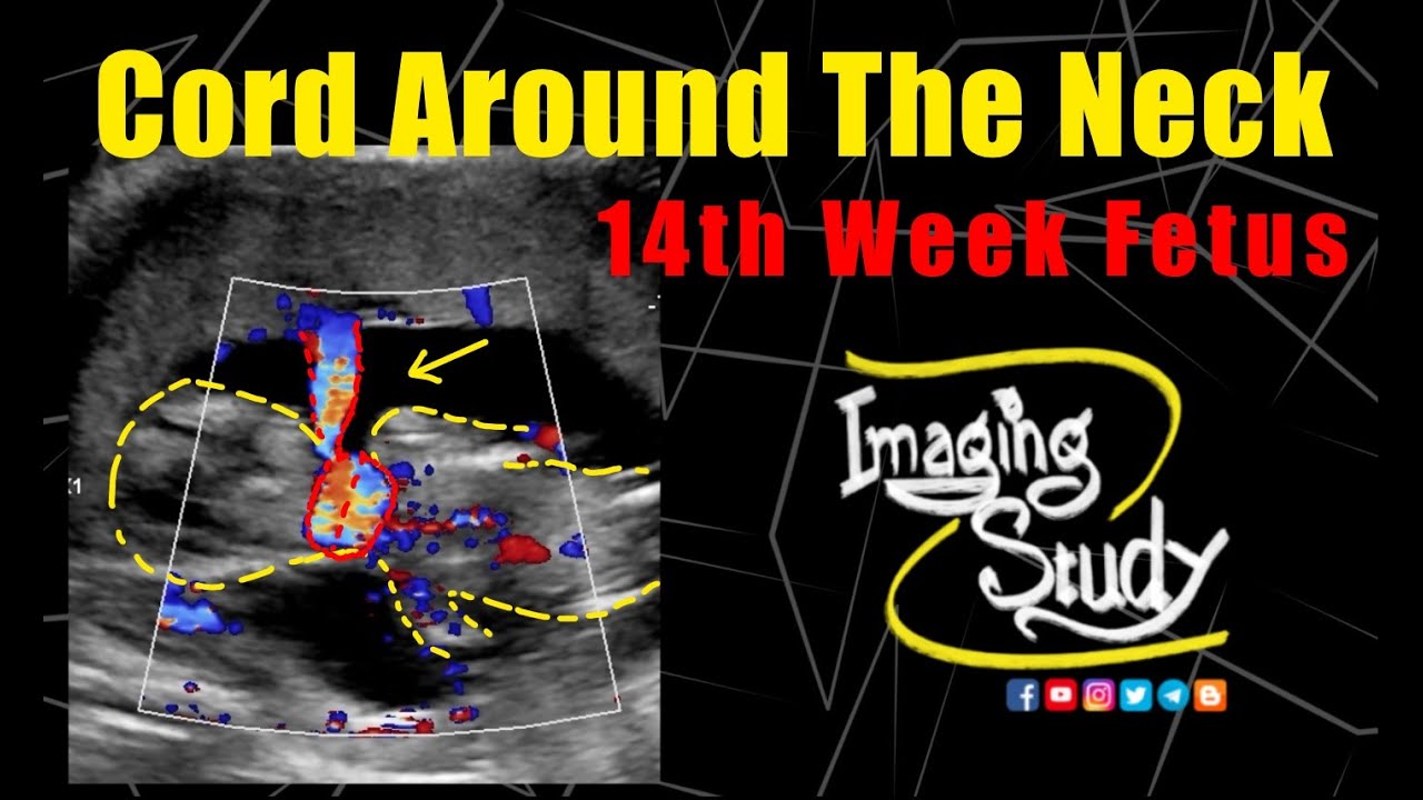 Two Layers of Cord Around The Neck of a 14th Week Fetus || Ultrasound || Doppler || Case 327