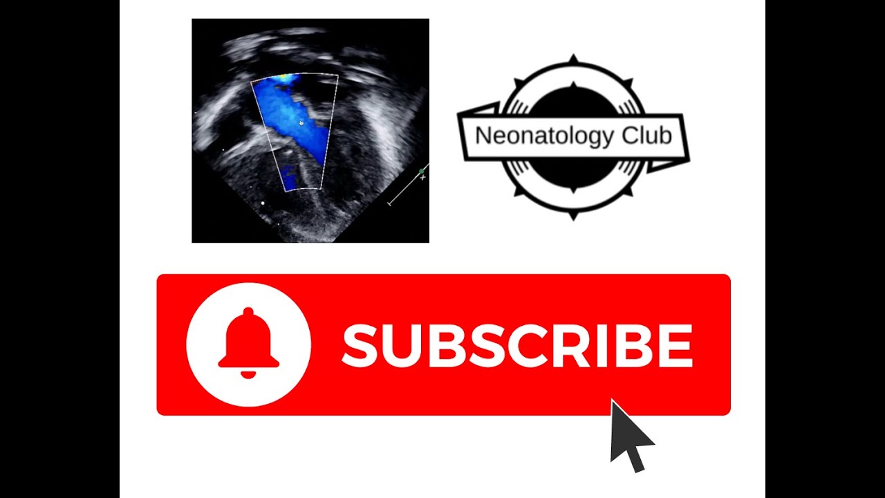 Calculating left ventricular output