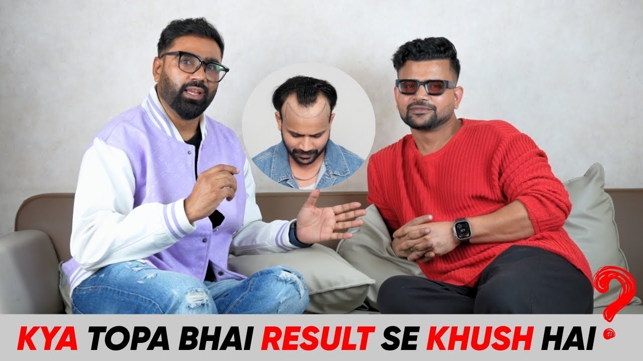 Sevengers fame Topa Bhai ka 15 Months Hair Transplant Experience | Kya Hairfall ho raha hai ?