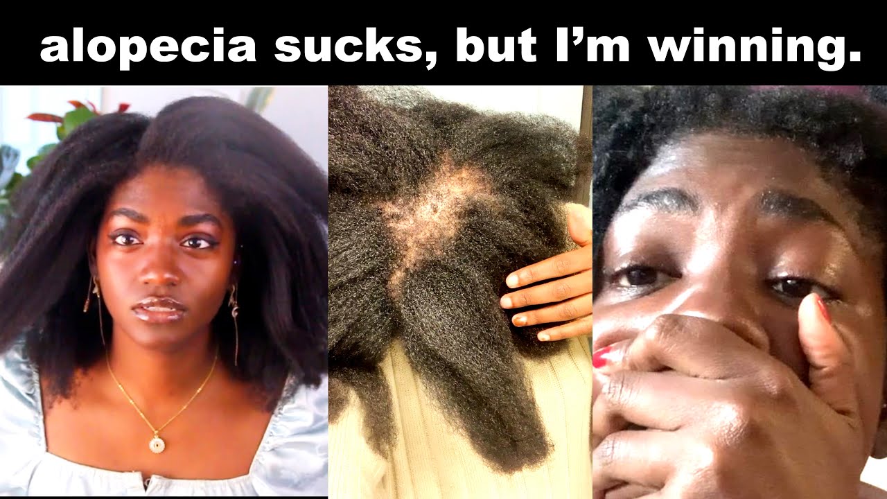How I beat alopecia | 4C Natural Hair