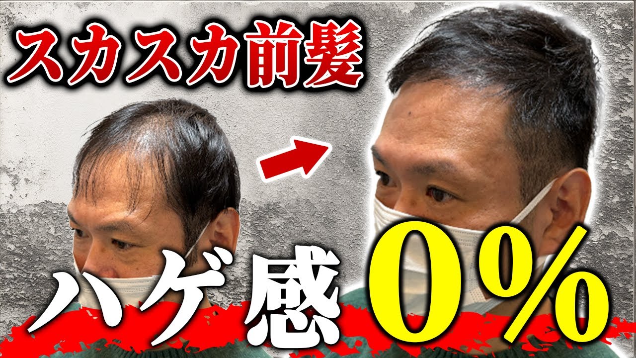 【前髪ハゲ】猫っ毛と薄毛でセットに悩むモデルさん。超自然にカバーできるドライヤー方法をレクチャー