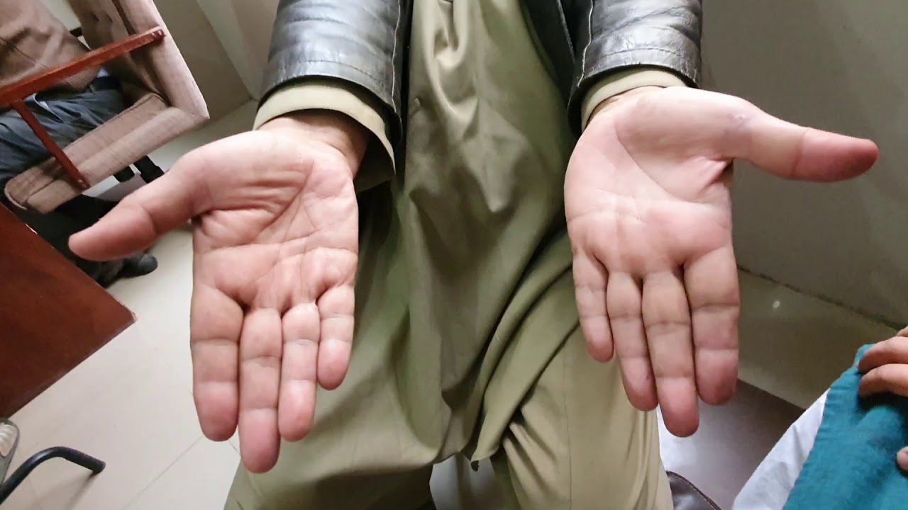 Thenar and Hypothenar Atrophy