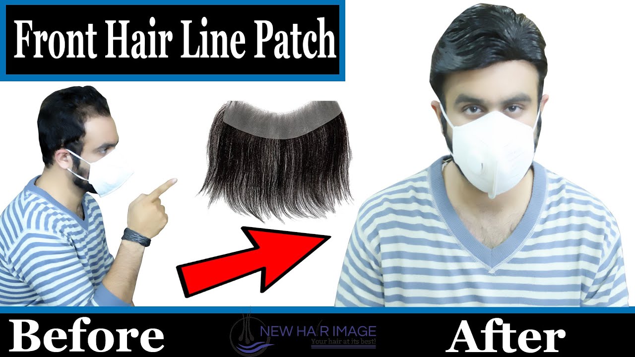 Front Hairline Hair Patch: Hairline Receding Solution | Customised Hairline Patch | New Hair Image