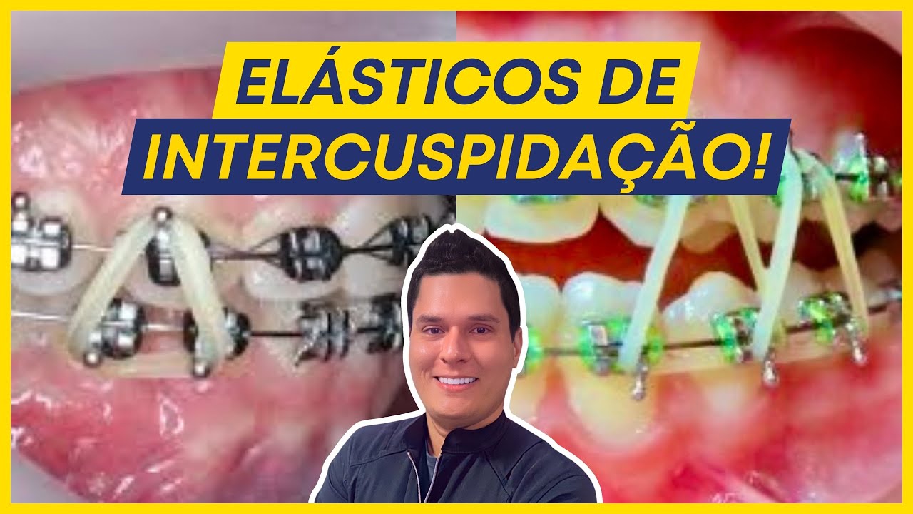 Elásticos de Intercuspidação em Ortodontia - Box e Triângulo (Guia Prático)