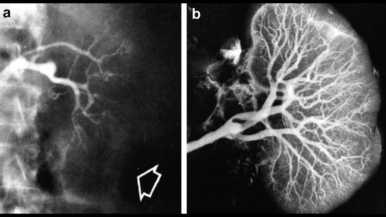 Síndrome Hepatorrenal