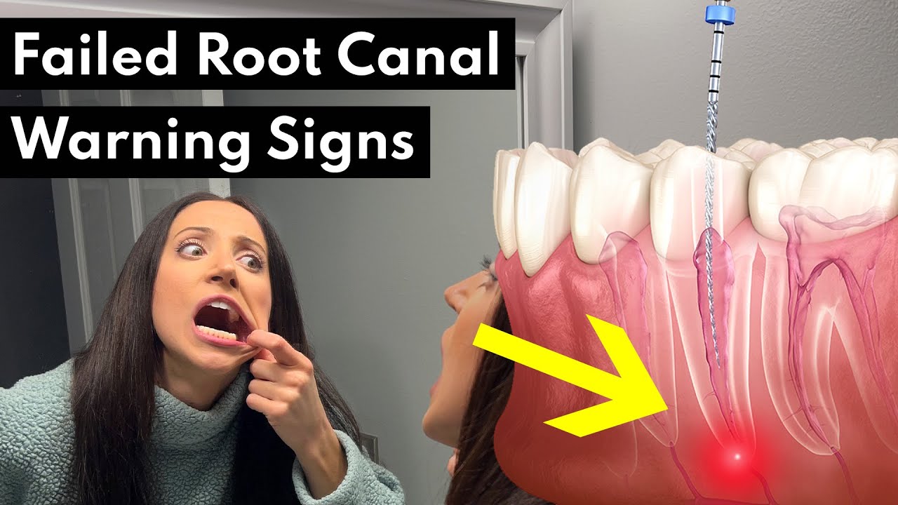 7 Warning Signs Your Root Canal FAILED