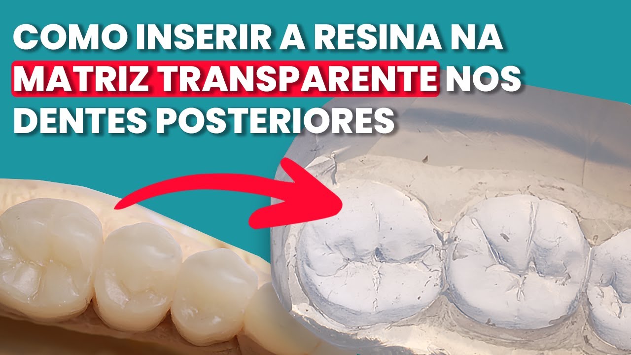 DENTE POSTERIOR EM RESINA COMPOSTA SEM ESCULTURA   Mylene e Renato