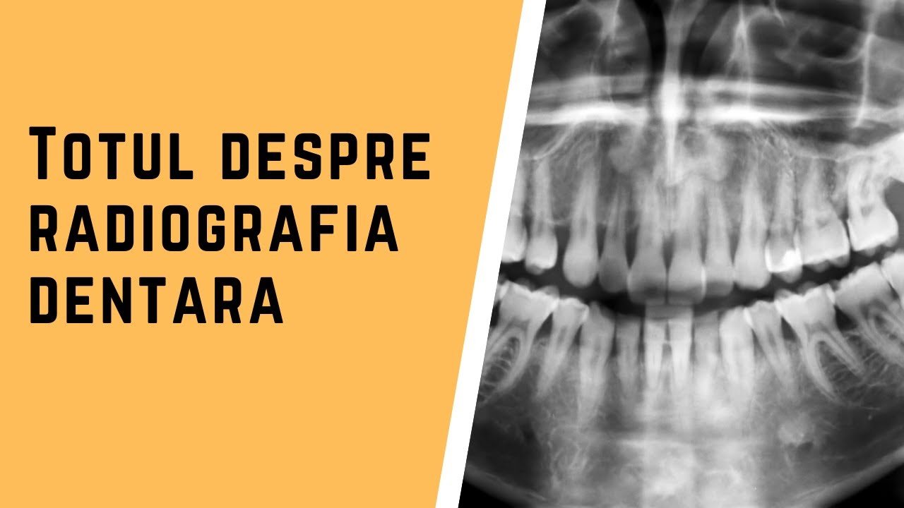 Totul despre radiografia dentara