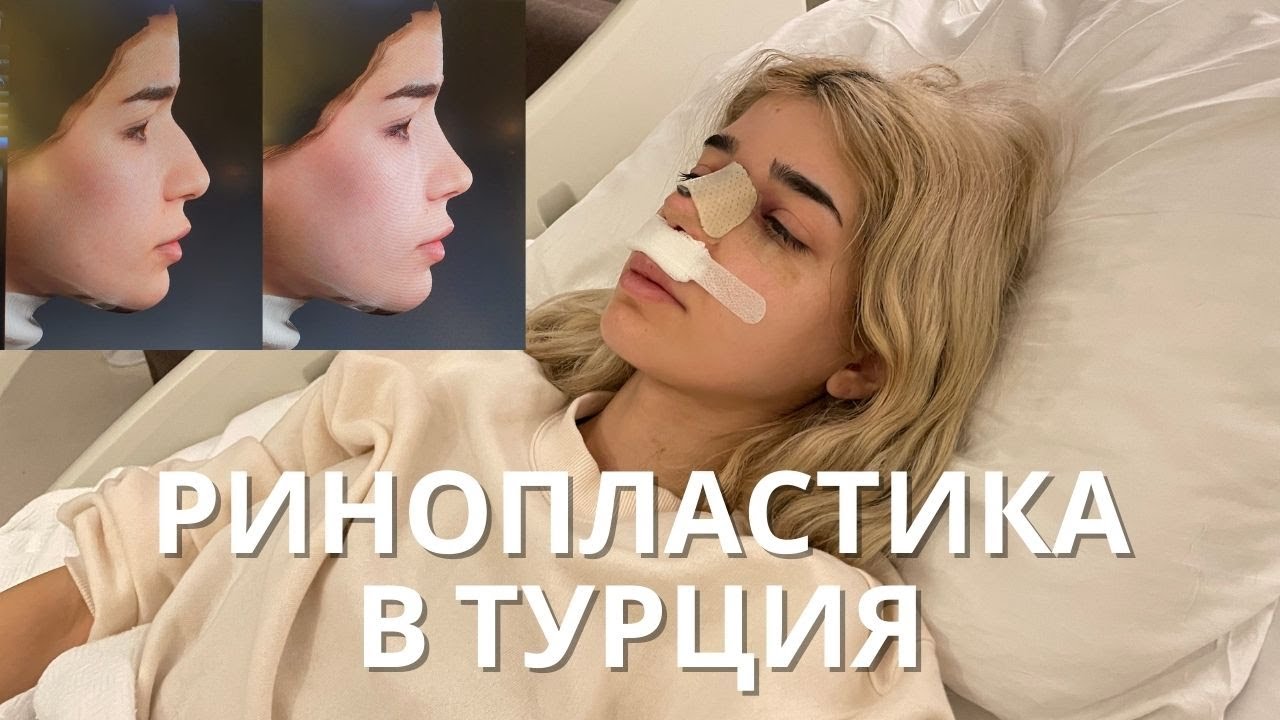 Ринопластика част 2 - преди и след операция