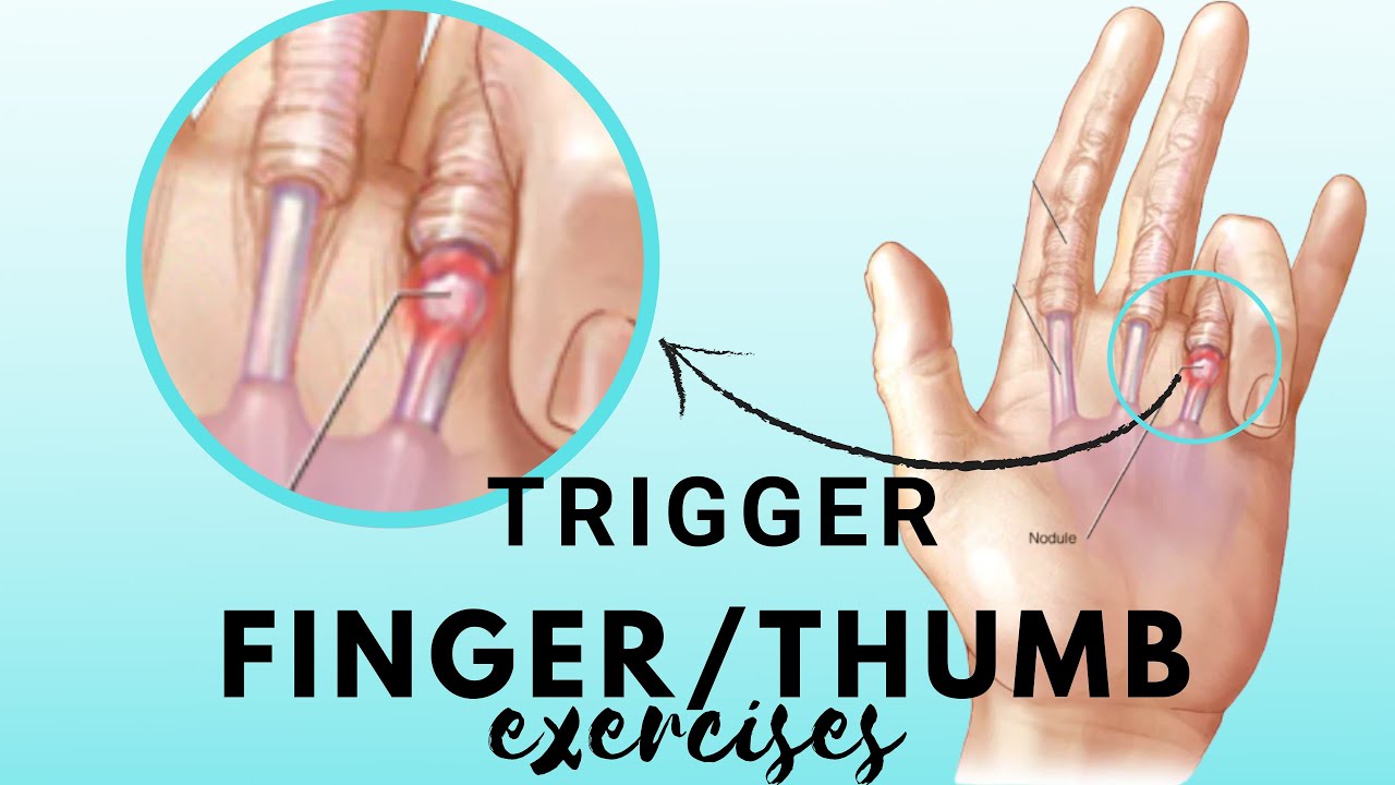 GET RID of TRIGGER FINGER and/or Trigger Thumb | with Nichelle Thomson