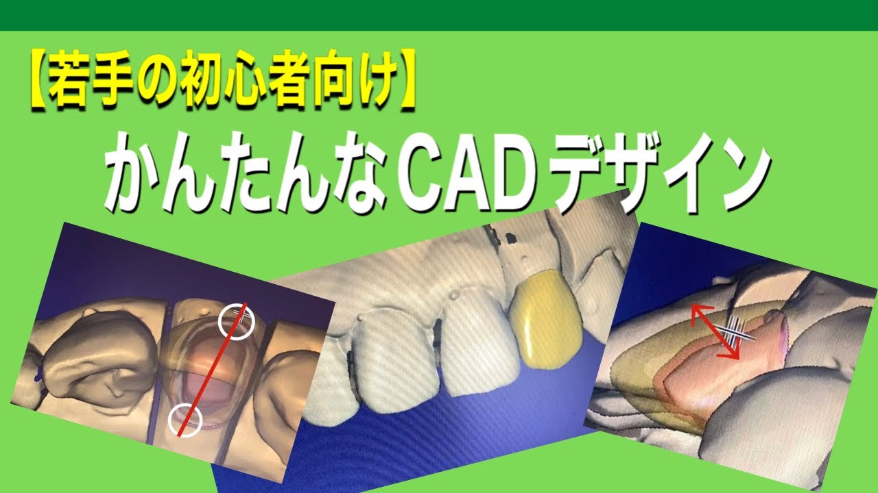 【若手歯科技工士】CADが苦手な若手向けのCADの手順。前歯CAD／CAM冠【exocad3.0】