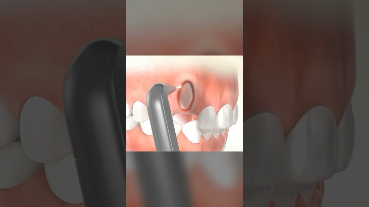 Laser Exposure of Impacted Canine #shorts #orthodontics #braces #dentist #bds #neetmds #teeth #easy
