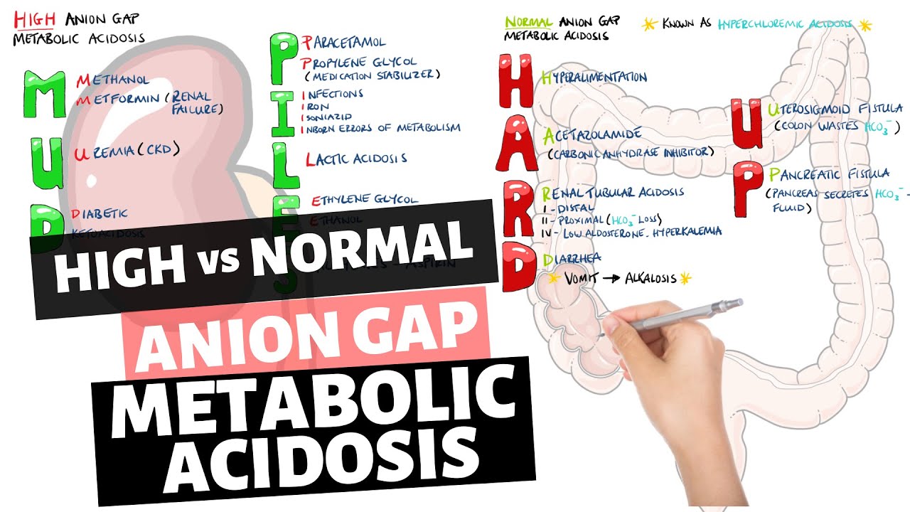 High vs Normal Anion Gap Metabolic Acidosis - Mnemonic (MUDPILES & HARD UP)