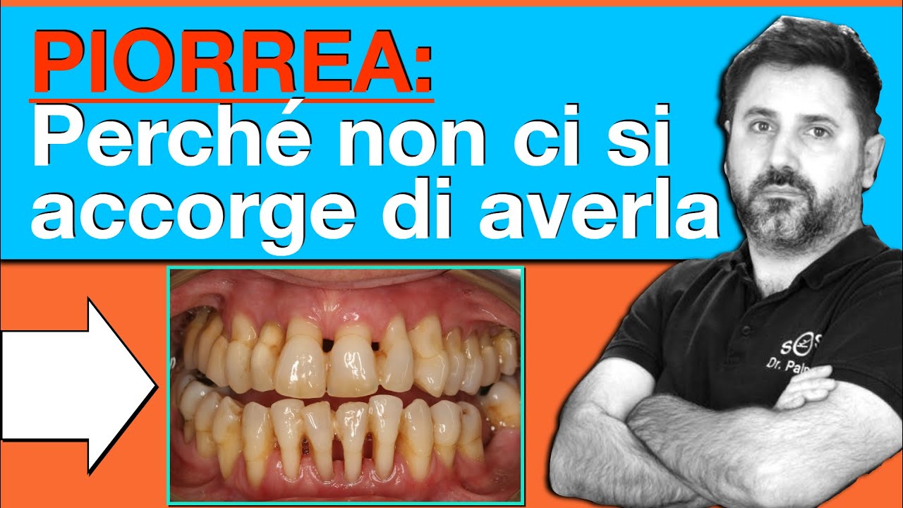 Un male silente: Perché non ci si accorge di avere la piorrea