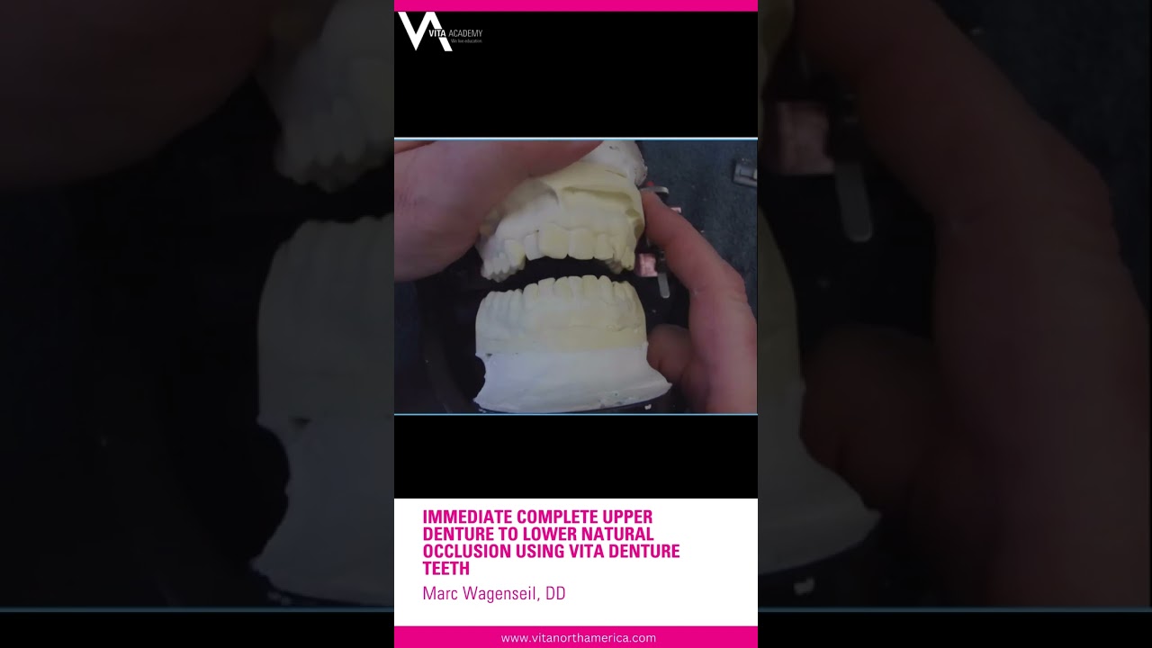 Immediate Complete Upper Denture to Lower Natural Occlusion Using VITA Denture Teeth