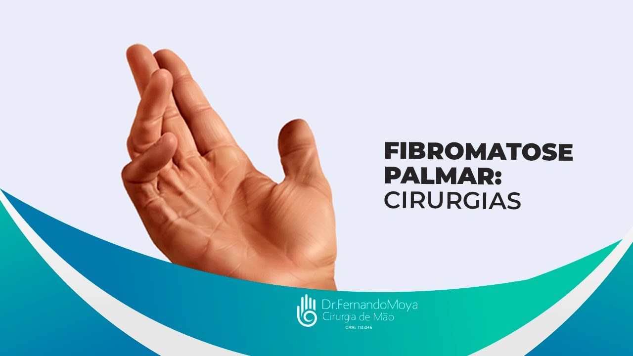 Fibromatose palmar: cirurgias | Dr. Fernando Moya CRM 112046