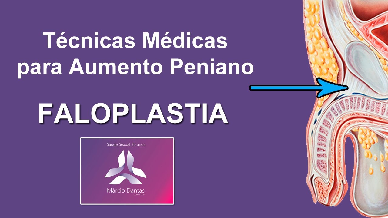 Cirurgia de Aumento Peniano (Aumento de Pênis, Faloplastia)