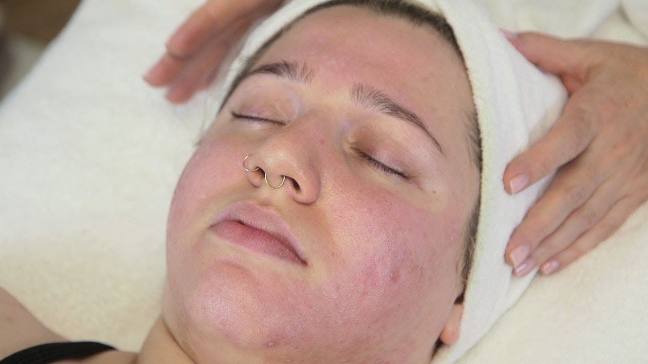 Facial Scarring Refinements: The Lactic Peel