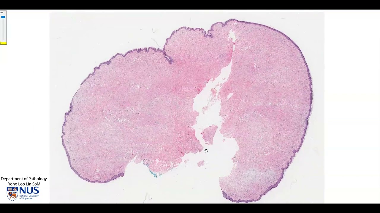 Skin Keloid Microscopy - Talking slide