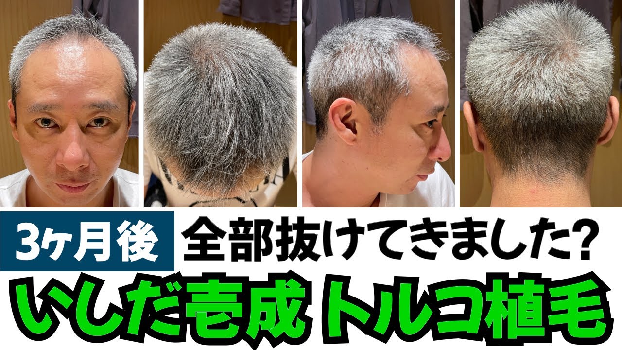 【芸能人】いしだ壱成 トルコ植毛 3ヶ月後までの経過【植毛大使｜治療｜薄毛の窓口】