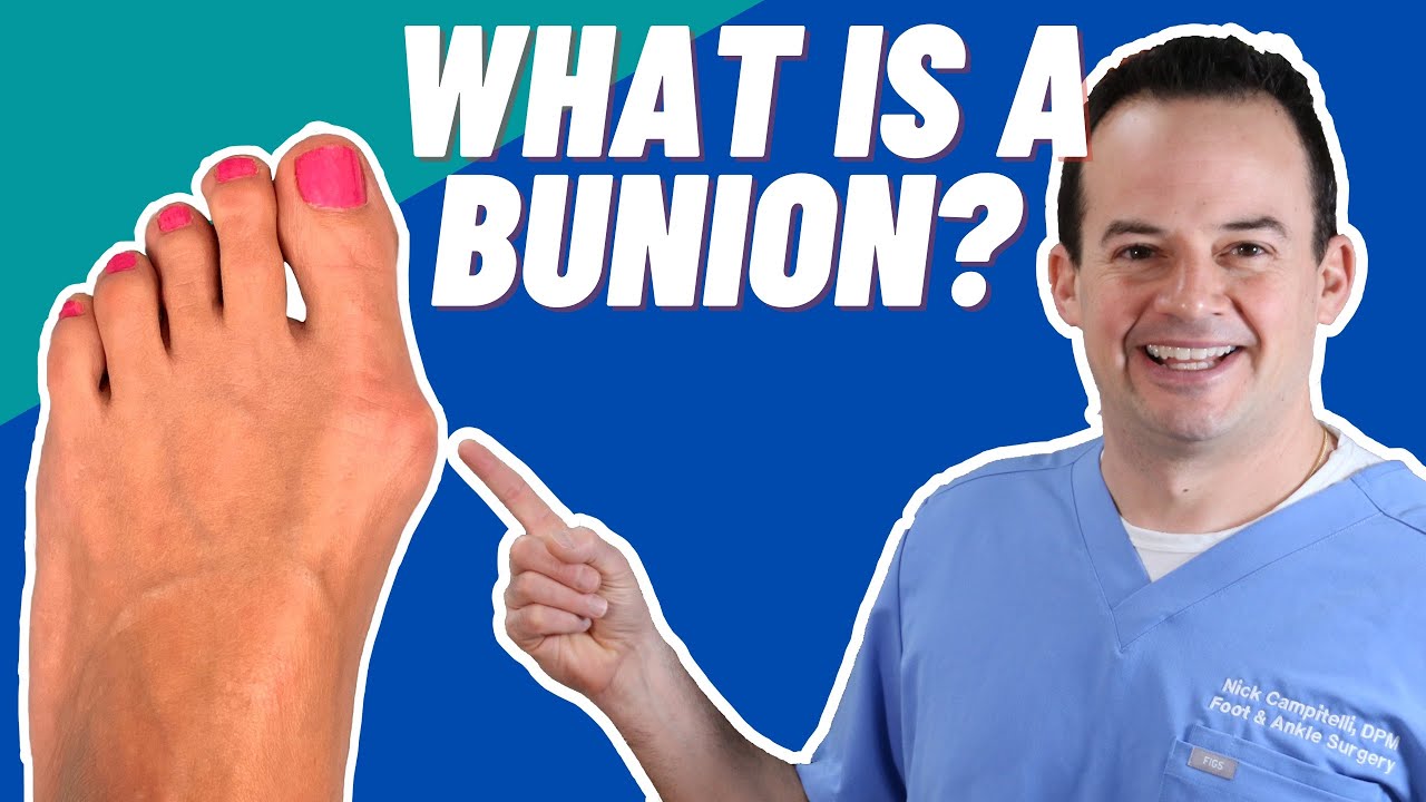 What is a Bunion? | Dr. Nick Campitelli
