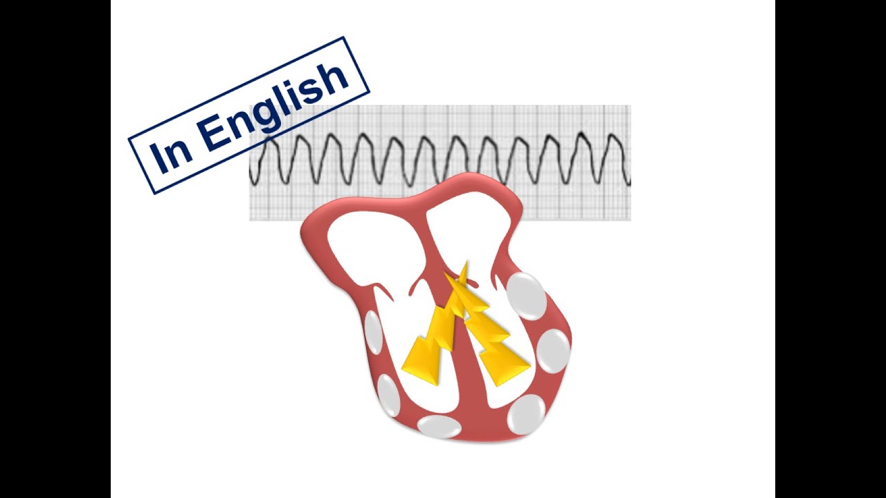 ESC Guidelines: 11. VAs in ARVC (English Version)
