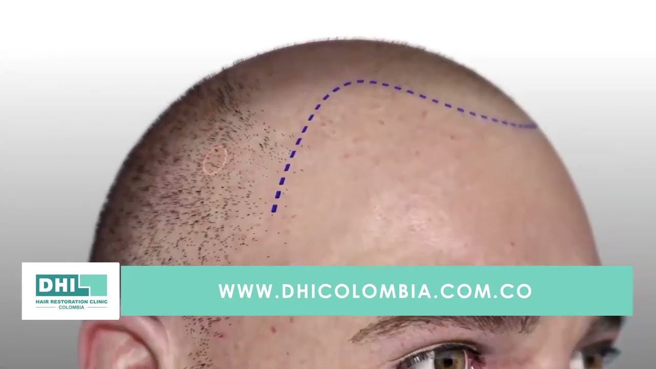¿En qué consiste la Técnica DHI?