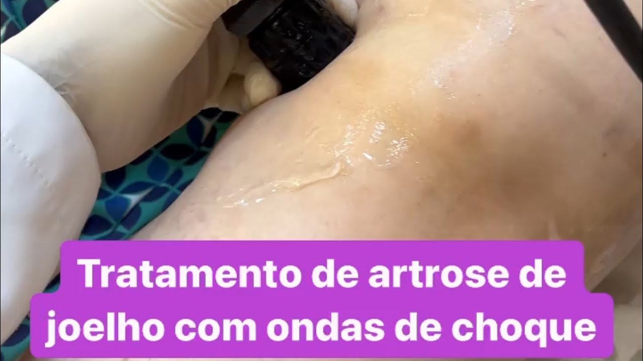 Tratamento de artrose no joelho com ondas de choque.