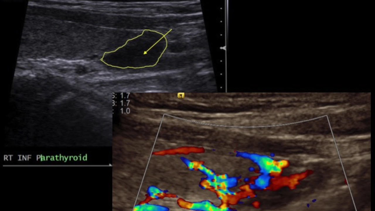TMT: Neck Ultrasound: Parathyroid Nodule