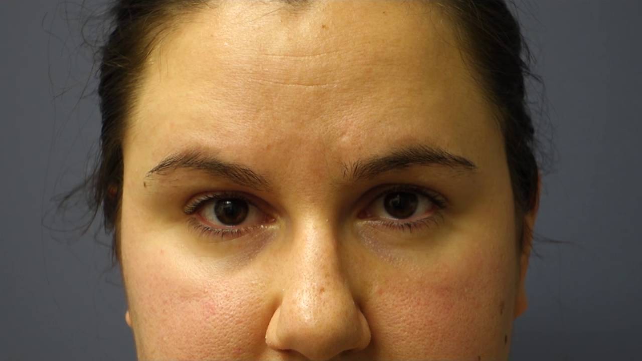 Blinking Exercises