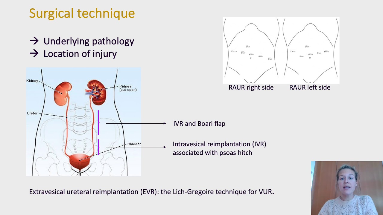 #117 Robotic ureteral reimplantation for mid and distal ureter pathology in adults: a case serie...