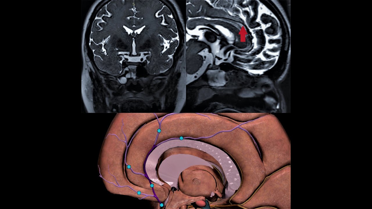ANTERIOR CEREBRAL ARTERY | RECURRENT ARTERY OF HEUBNER | MRI BASICS | ANATOMY