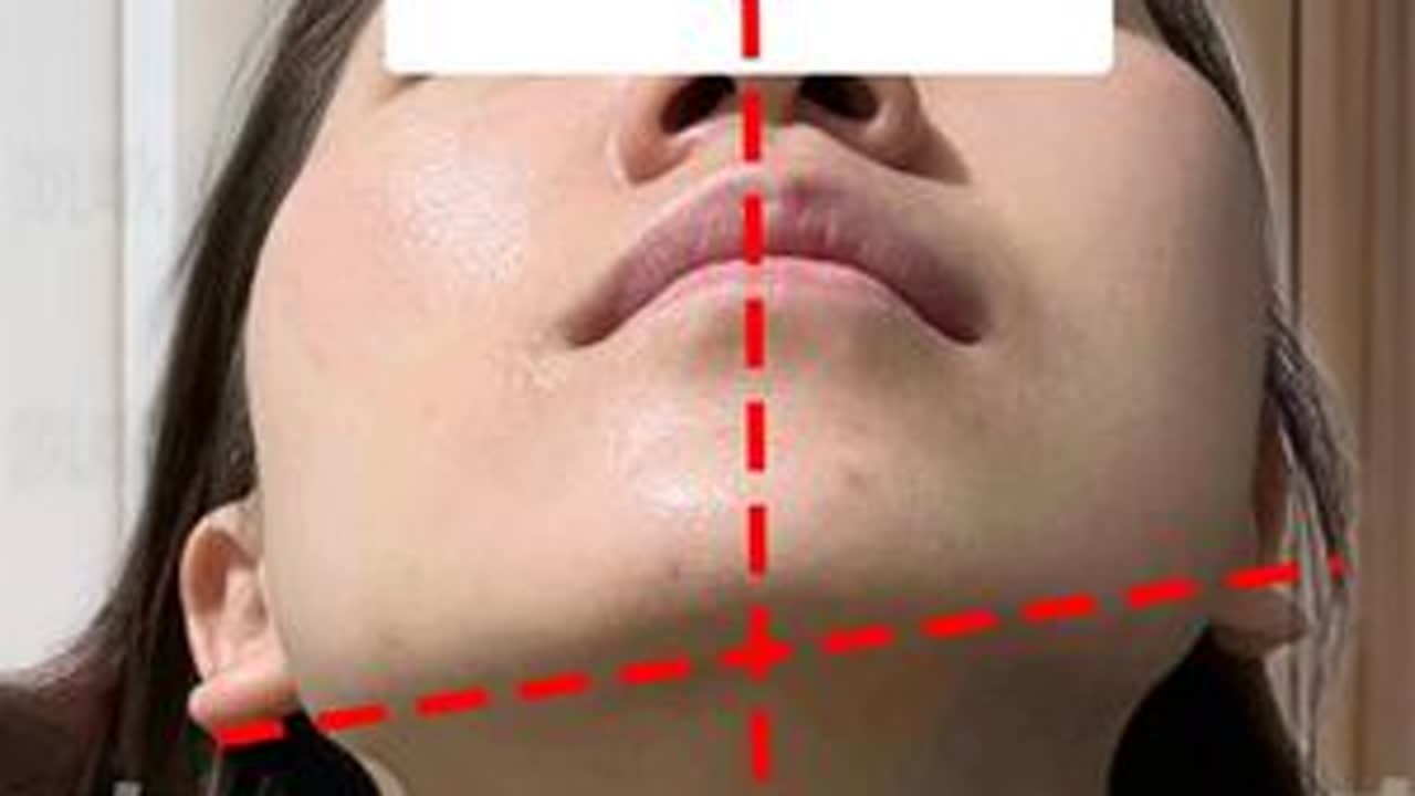 大小脸 下颌角一高一低怎么改善？！ #变美 #大小脸 #下巴歪 #面部提升