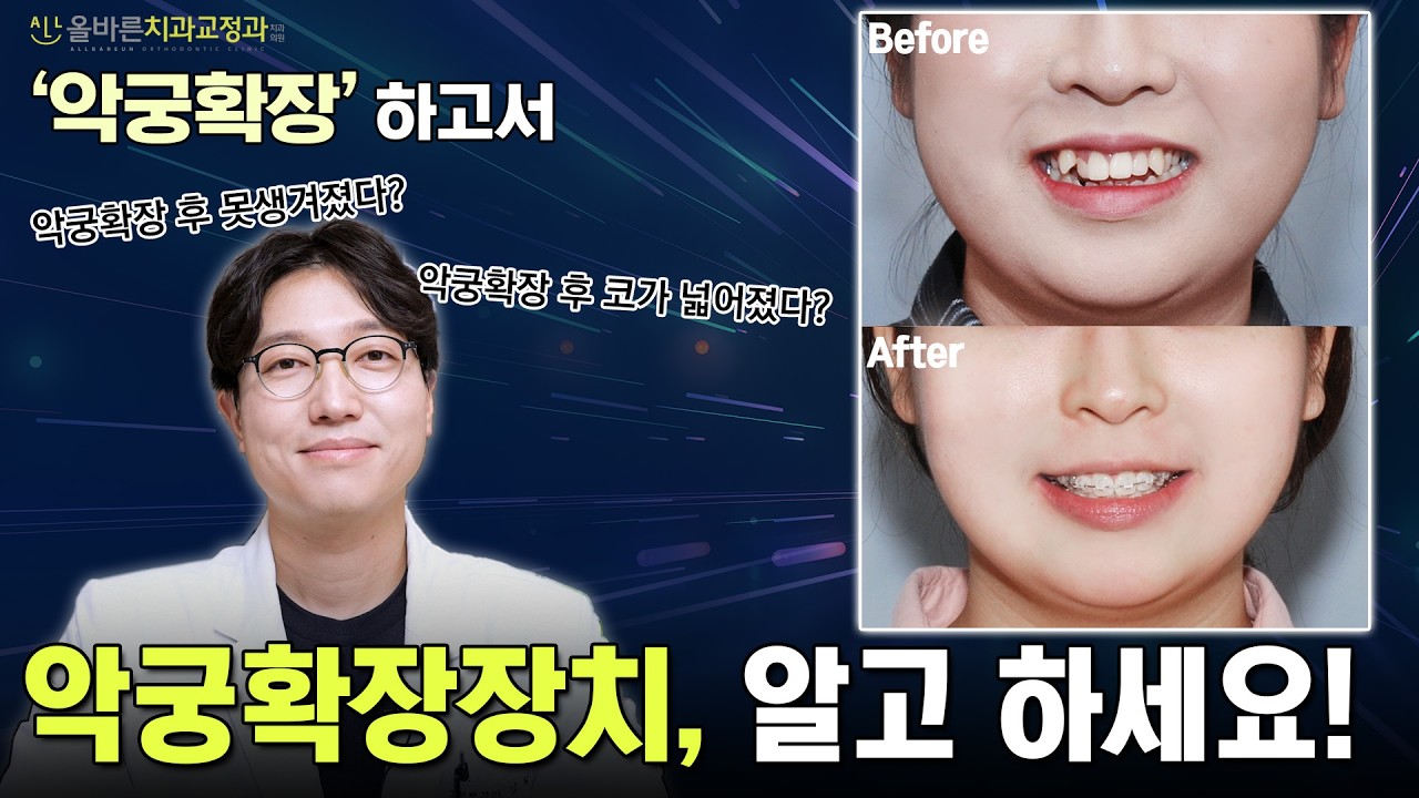 다물어지지 않는 치아… '이 장치' 하나로 바뀝니다😳 개방교합 교정 과정 공개🔥