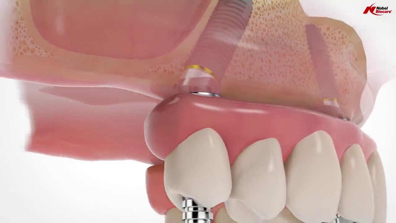 Implant DentarAll-on-4/ All-on-6®. Dantură fixă într-o singură zi!