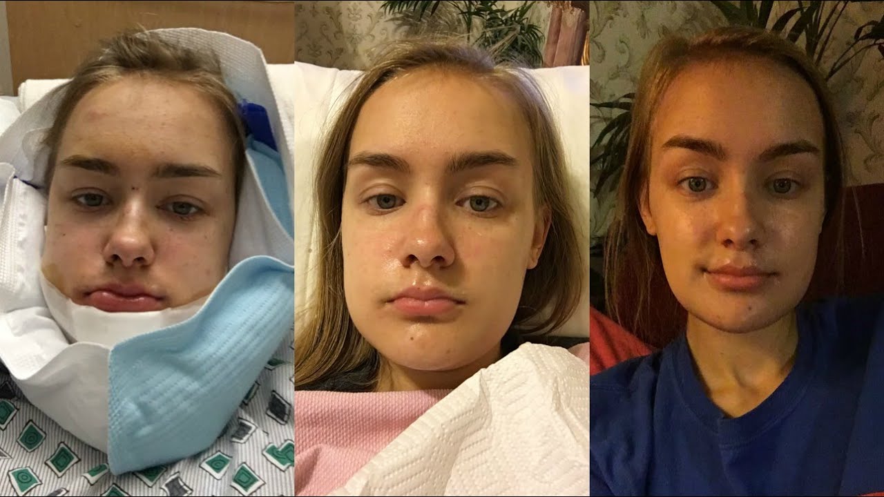 My Double Jaw Surgery Experience | 8 months post op