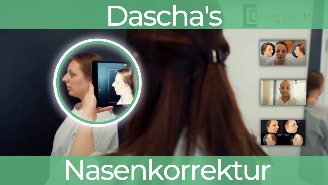 Meine komplette Nasenkorrektur bei Dr. Oliver Schumacher in Düsseldorf! (Nasen Operation)