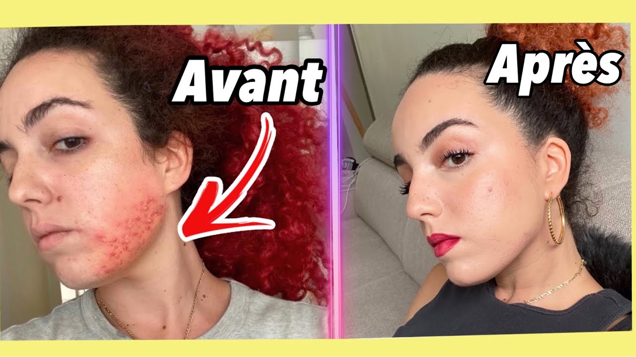 MON ACNÉ (à 28ans mdr)