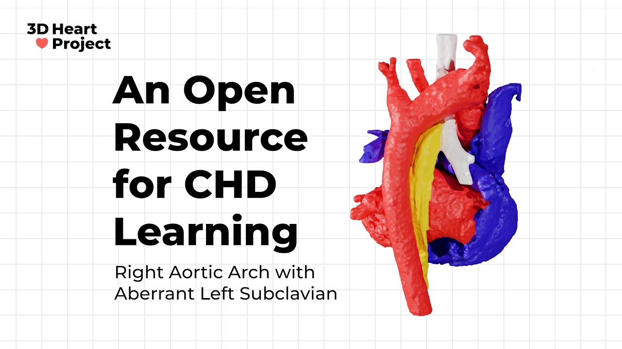 Right Aortic Arch with Aberrant Left Subclavian Artery Model Anatomy