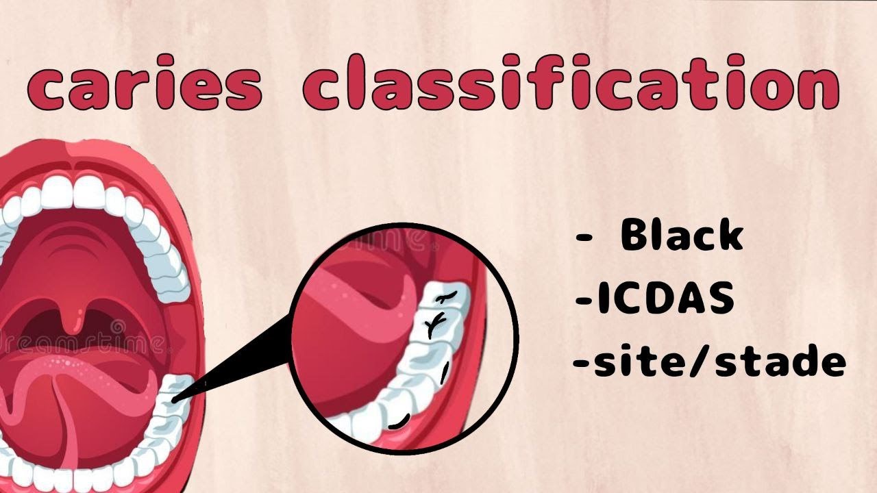 Dental Caries Classification: black's clases, ICDAS, and sites/stades