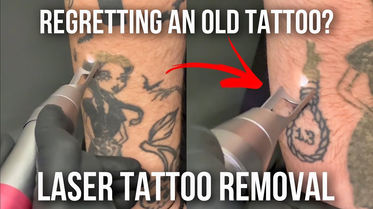 First Session of LASER TATTOO REMOVAL 😨 WOW!