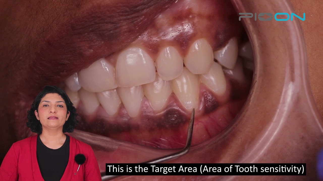 Treatment for Dentin Hypersensitivity using 980nm and 8mm tip