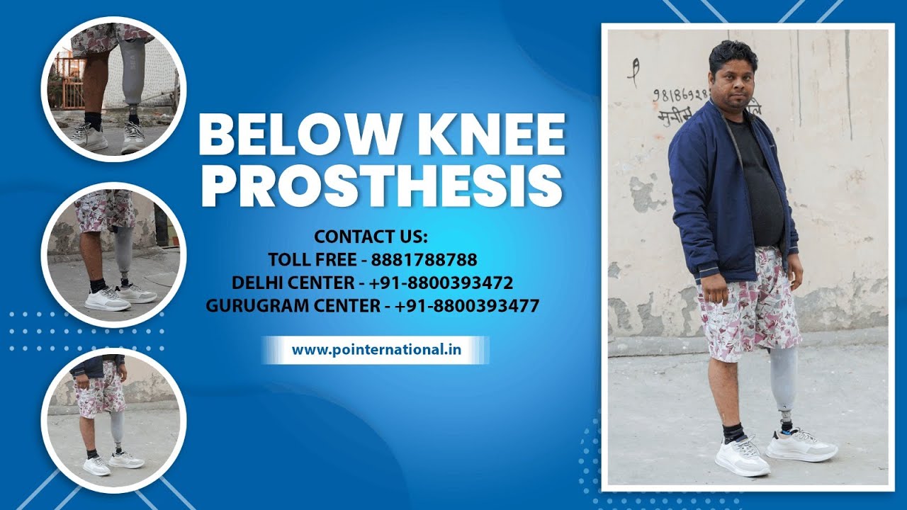 Hi-Tech Below Knee Prosthesis Transformation | Real Patient #Artificial_limb | P&O International
