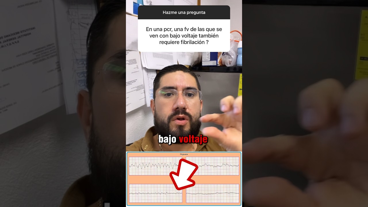 Fibrilaci&oacute;n ventricular fina 🫀⚡️ #emergency