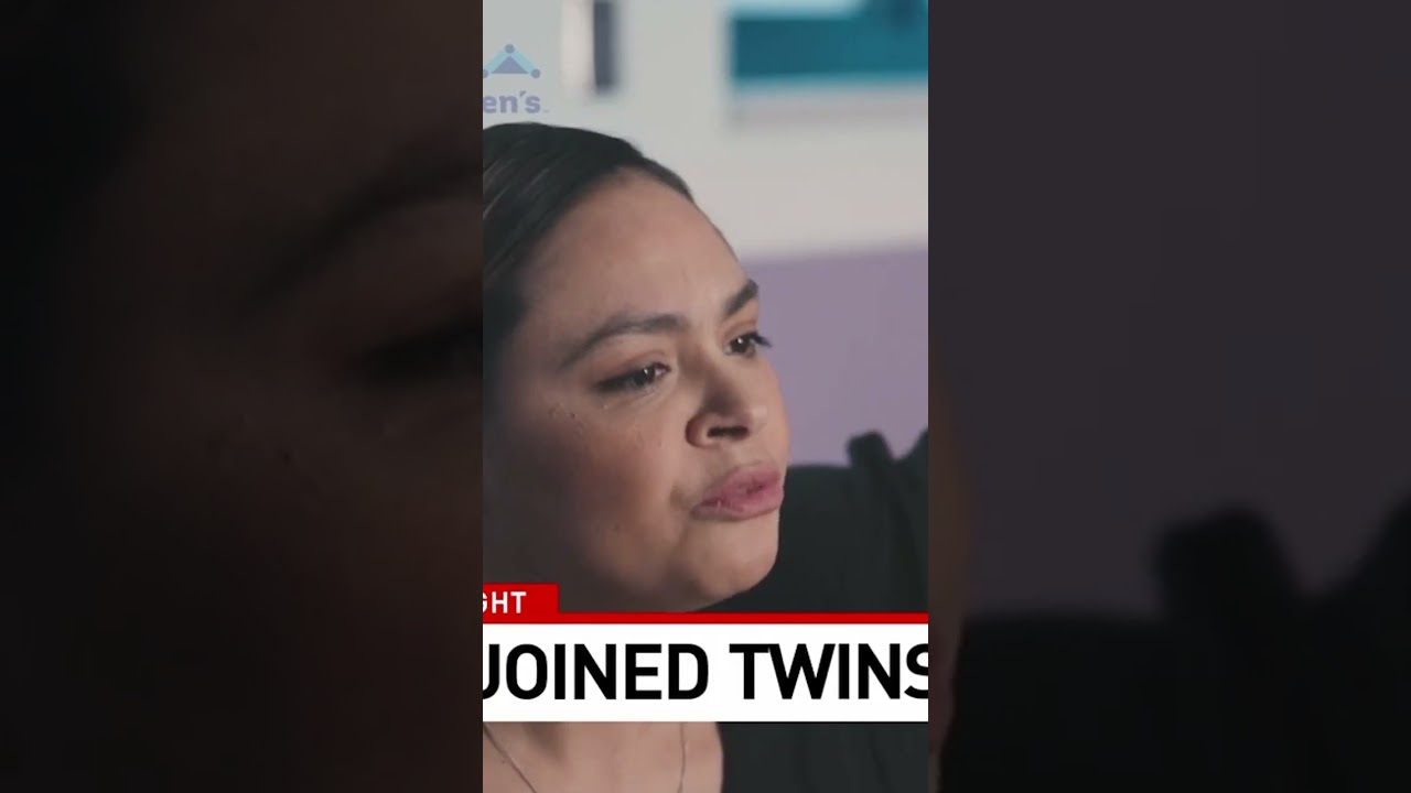 Conjoined twins separated after successful 11-hour surgery
