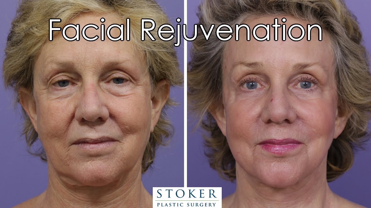 Facelift Los Angeles: Top Plastic Surgeon Dr. David Stoker Explains Facelift and Laser Surgery