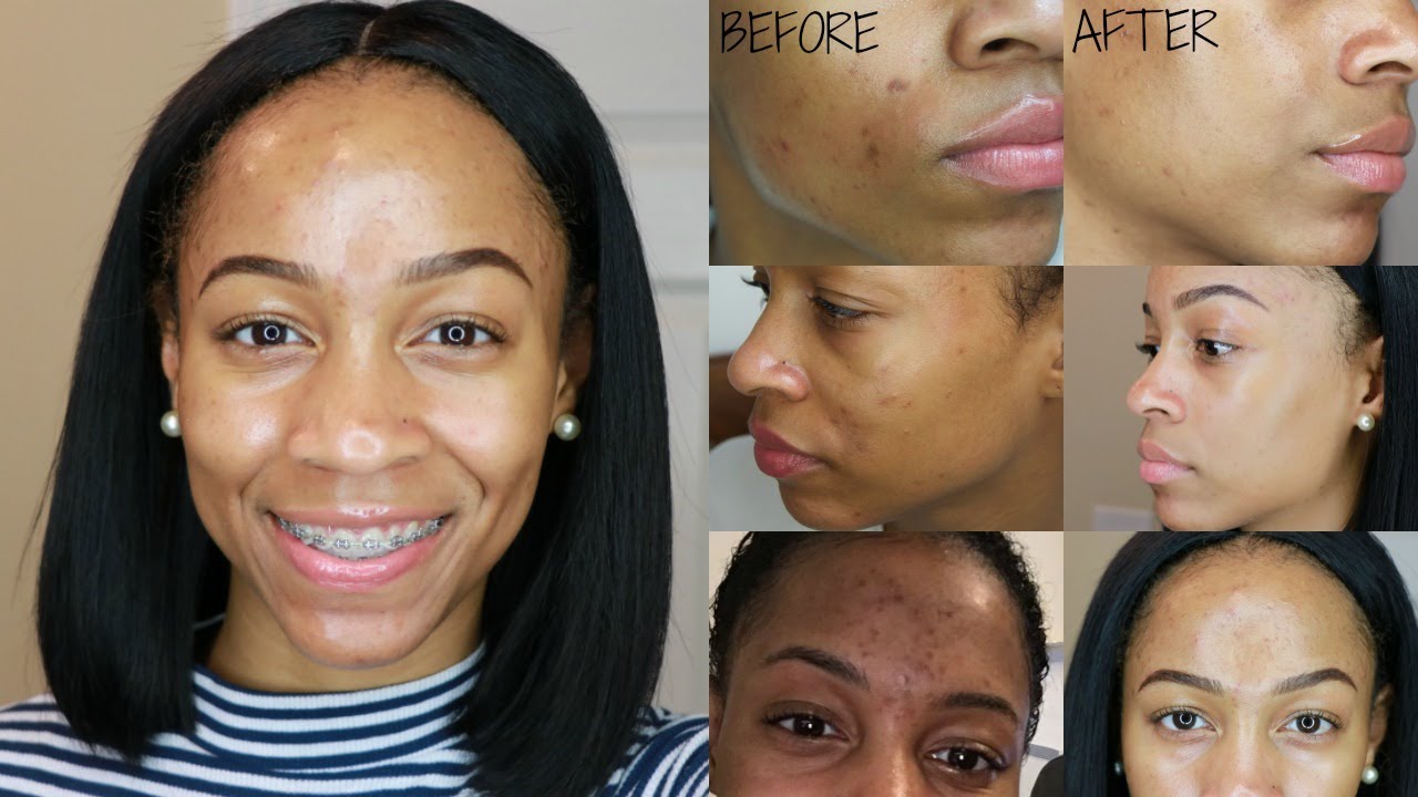How I Remove Dark Spots & Acne Scars || Nighttime Skincare Routine