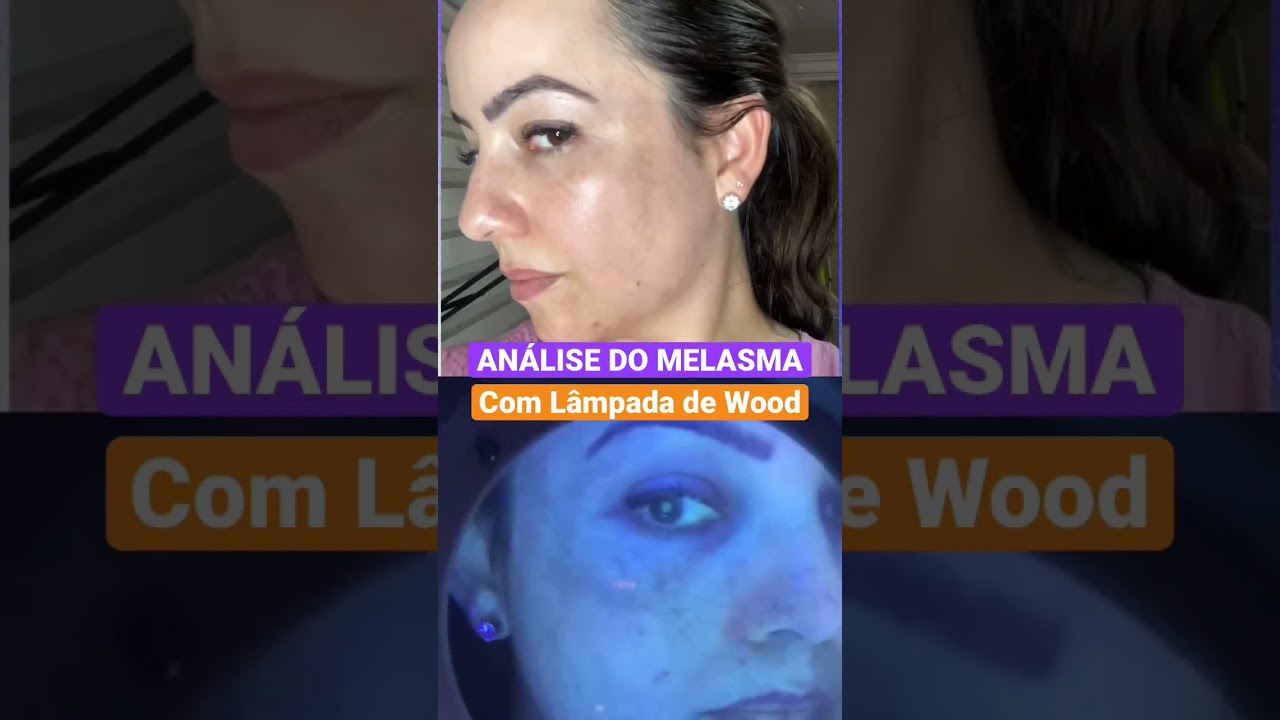 MELASMA ANÁLISE COM LÂMPADA DE WOOD 