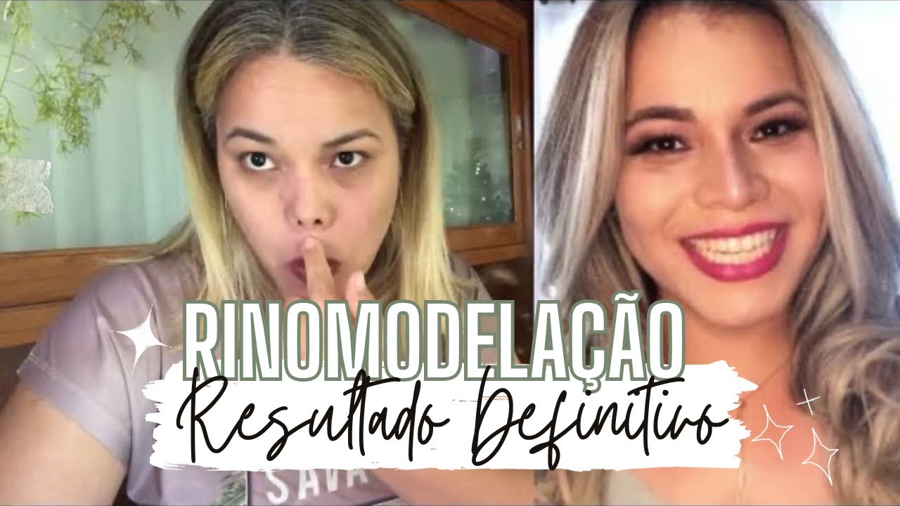 1 ANO APÓS A RINOMODELAÇÃO, ÚLTIMO DIA USANDO MICROPORE COMO O NARIZ FICOU. 