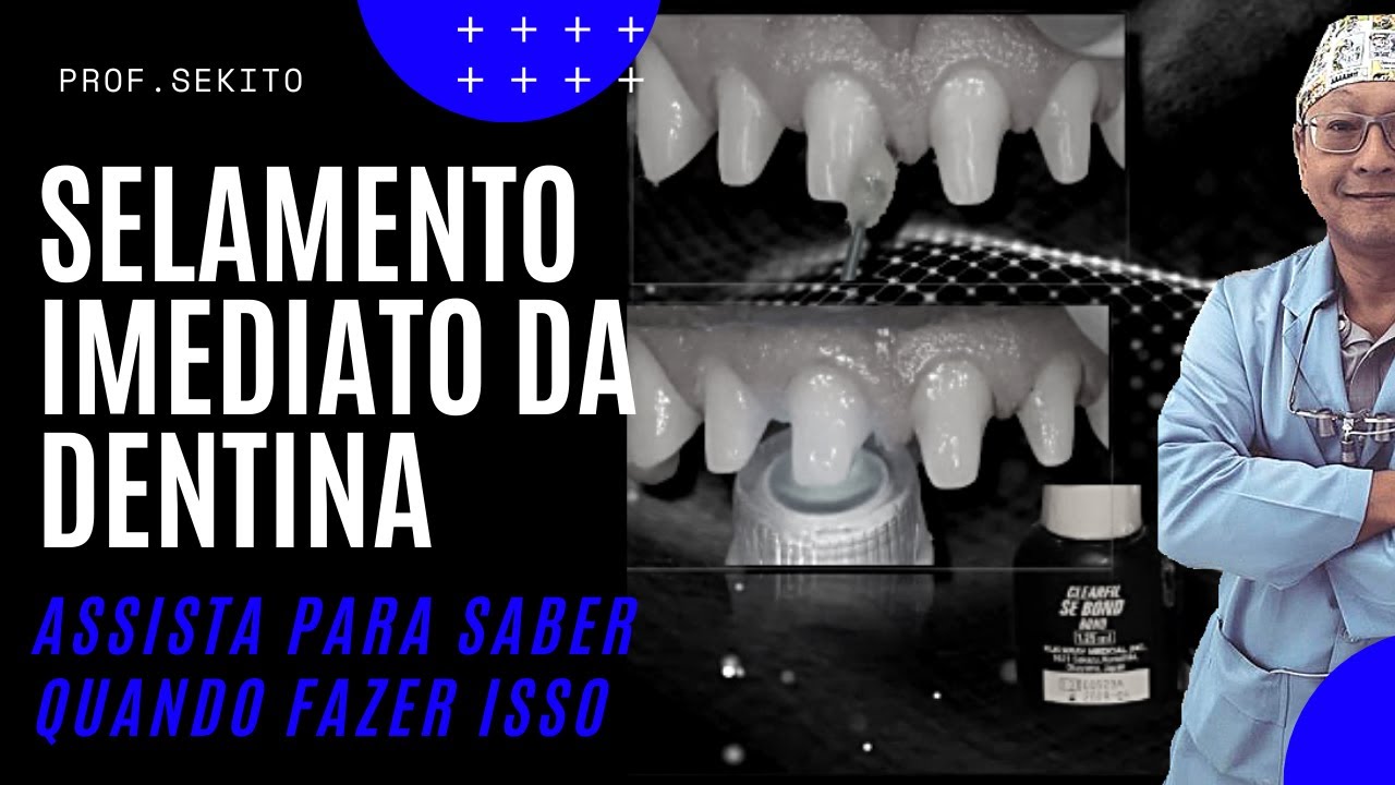 Selamento Imediato da dentina. Quando e como fazer?